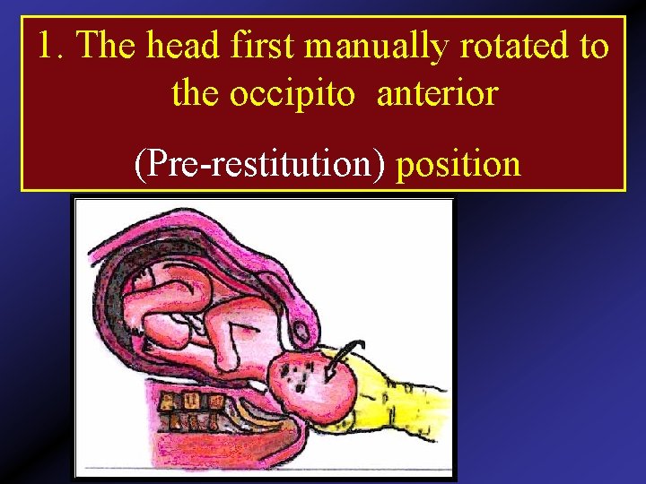 1. The head first manually rotated to the occipito anterior (Pre-restitution) position 