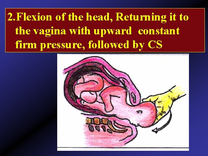 2. Flexion of the head, Returning it to the vagina with upward constant firm