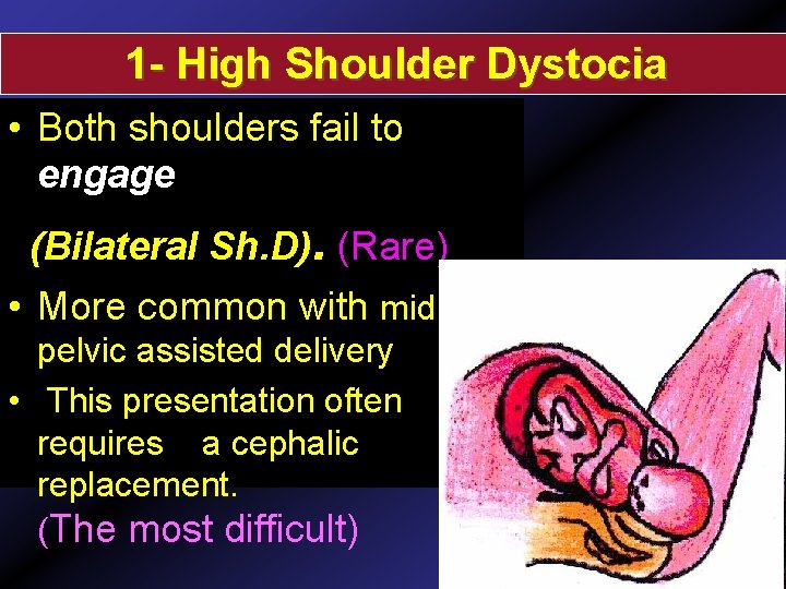1 - High Shoulder Dystocia • Both shoulders fail to engage (Bilateral Sh. D).