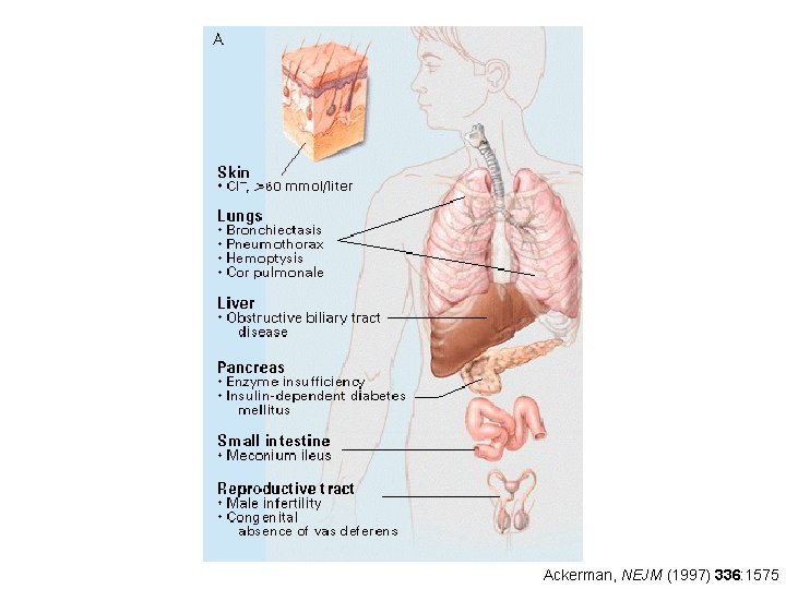 Ackerman, NEJM (1997) 336: 1575 