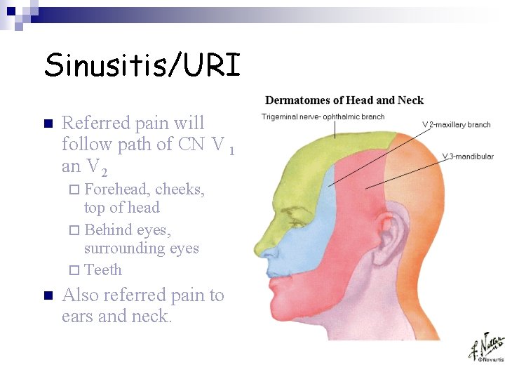 Sinusitis/URI n Referred pain will follow path of CN V 1 an V 2