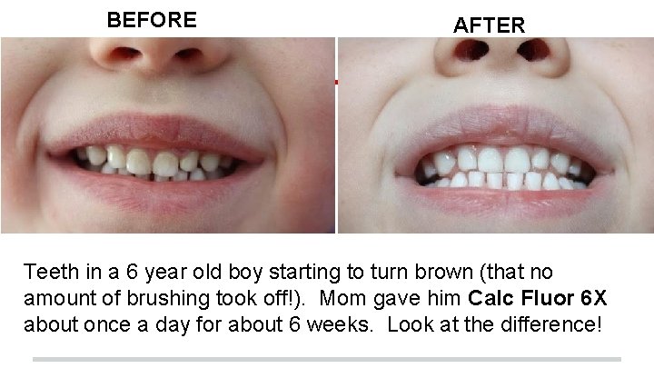 BEFORE AFTER Teeth in a 6 year old boy starting to turn brown (that