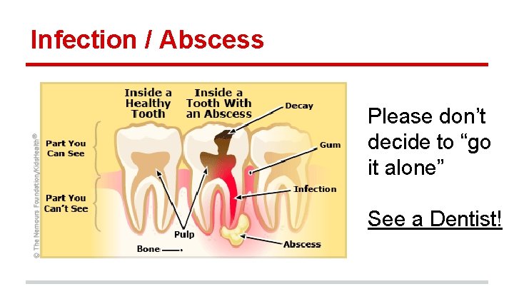 Infection / Abscess Please don’t decide to “go it alone” See a Dentist! 