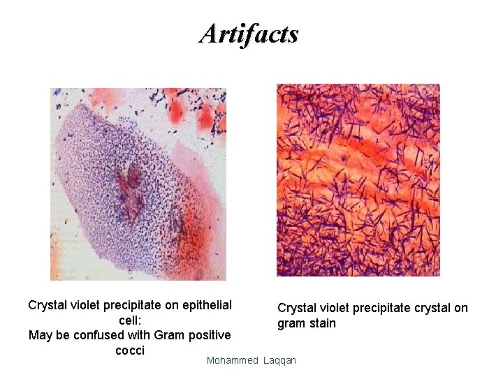 Artifacts Crystal violet precipitate on epithelial cell: May be confused with Gram positive cocci
