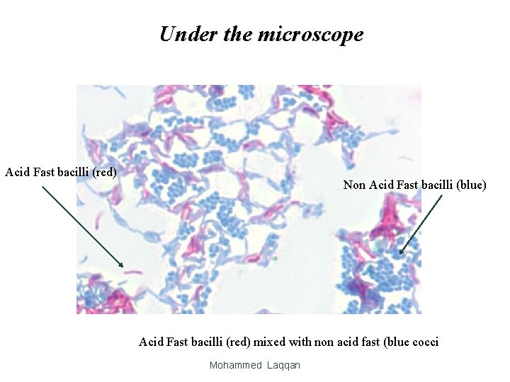 Under the microscope Acid Fast bacilli (red) Non Acid Fast bacilli (blue) Acid Fast