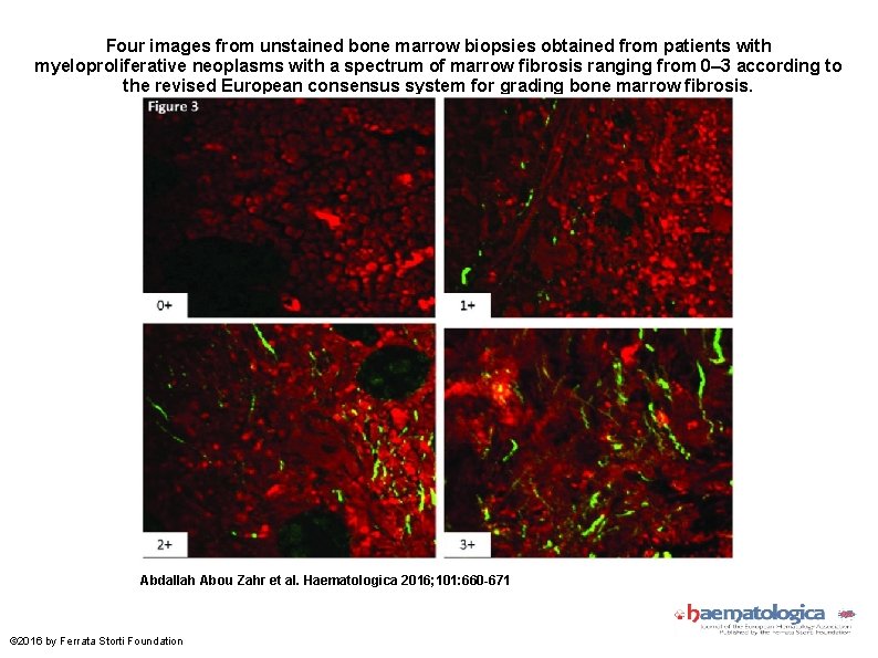 Four images from unstained bone marrow biopsies obtained from patients with myeloproliferative neoplasms with