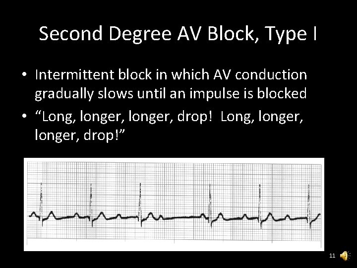 Second Degree AV Block, Type I • Intermittent block in which AV conduction gradually