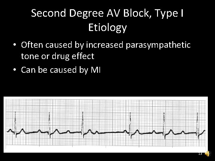 Second Degree AV Block, Type I Etiology • Often caused by increased parasympathetic tone