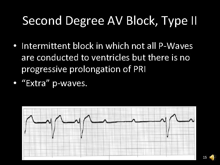 Second Degree AV Block, Type II • Intermittent block in which not all P-Waves