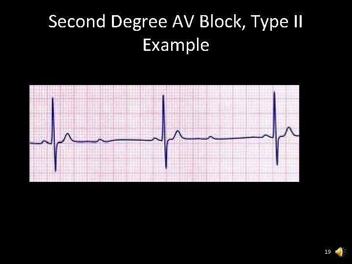 Second Degree AV Block, Type II Example 19 