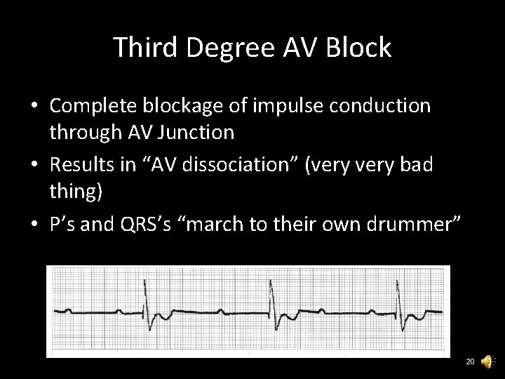 Third Degree AV Block • Complete blockage of impulse conduction through AV Junction •