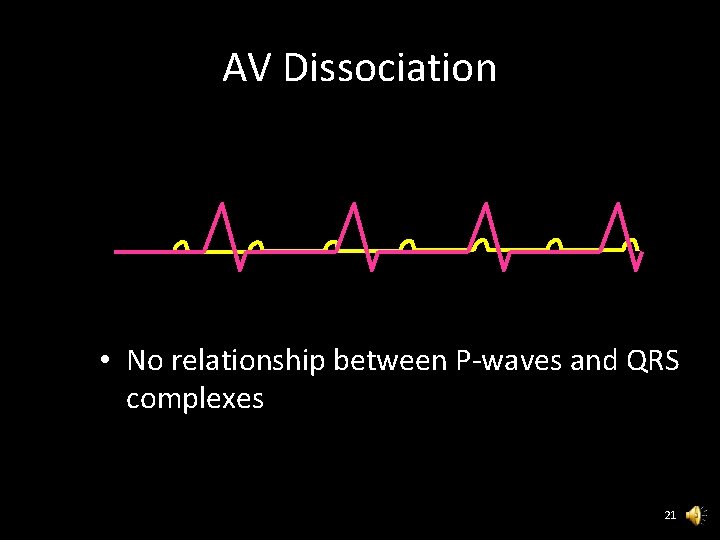 AV Dissociation • No relationship between P-waves and QRS complexes 21 