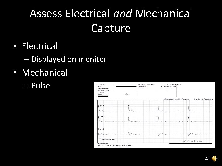 Assess Electrical and Mechanical Capture • Electrical – Displayed on monitor • Mechanical –