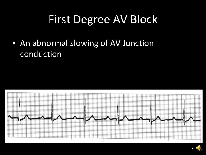 First Degree AV Block • An abnormal slowing of AV Junction conduction 7 