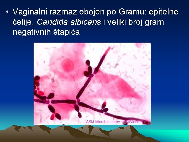  • Vaginalni razmaz obojen po Gramu: epitelne ćelije, Candida albicans i veliki broj