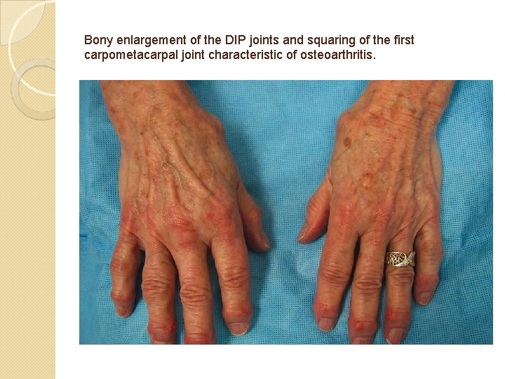 Bony enlargement of the DIP joints and squaring of the first carpometacarpal joint characteristic