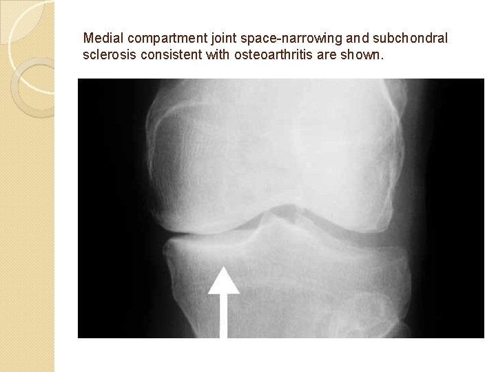 Medial compartment joint space-narrowing and subchondral sclerosis consistent with osteoarthritis are shown. 