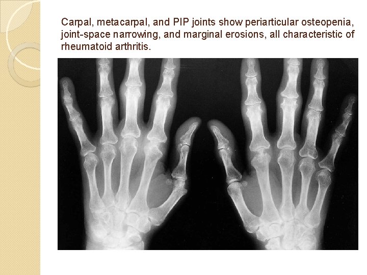 Carpal, metacarpal, and PIP joints show periarticular osteopenia, joint-space narrowing, and marginal erosions, all