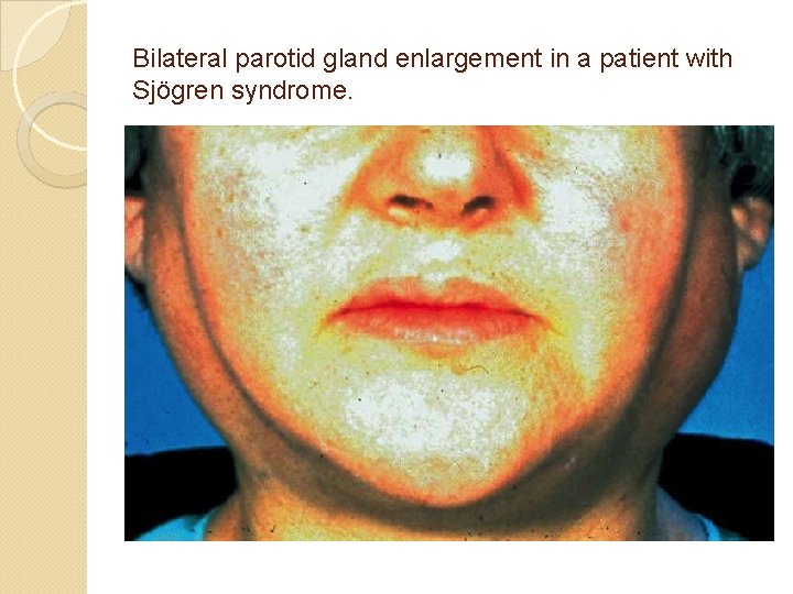 Bilateral parotid gland enlargement in a patient with Sjögren syndrome. 