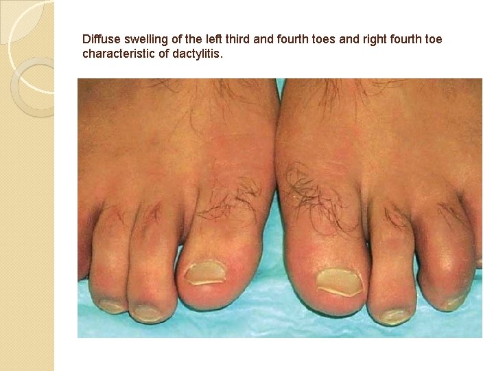 Diffuse swelling of the left third and fourth toes and right fourth toe characteristic