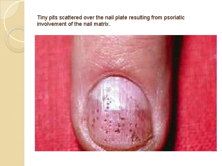 Tiny pits scattered over the nail plate resulting from psoriatic involvement of the nail