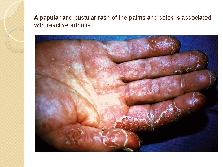A papular and pustular rash of the palms and soles is associated with reactive