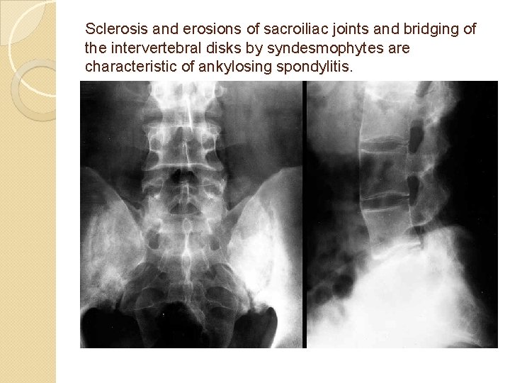 Sclerosis and erosions of sacroiliac joints and bridging of the intervertebral disks by syndesmophytes