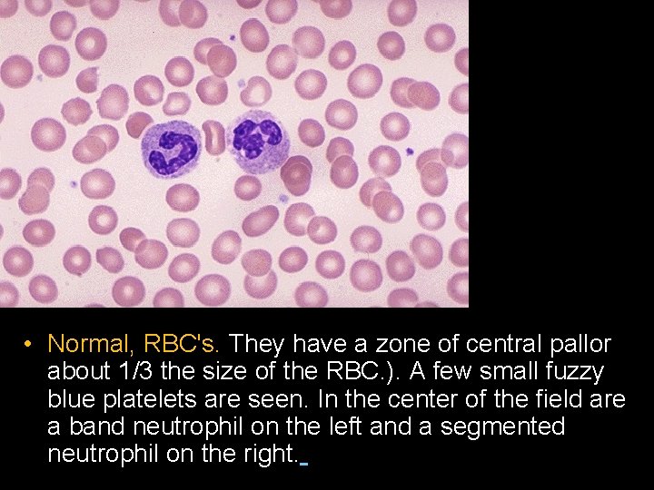  • Normal, RBC's. They have a zone of central pallor about 1/3 the