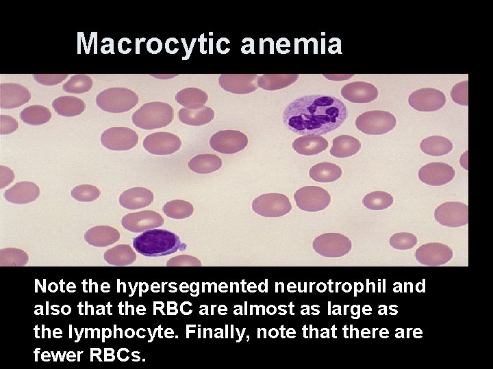 Macrocytic anemia Note the hypersegmented neurotrophil and also that the RBC are almost as