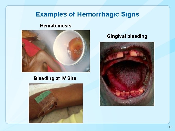 Examples of Hemorrhagic Signs Hematemesis Gingival bleeding Bleeding at IV Site 17 