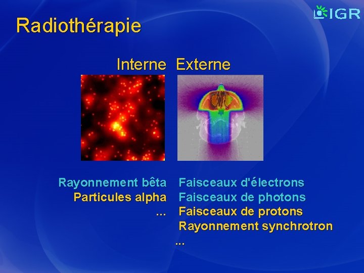 Radiothérapie Interne Externe Rayonnement bêta Faisceaux d'électrons Particules alpha Faisceaux de photons. . .