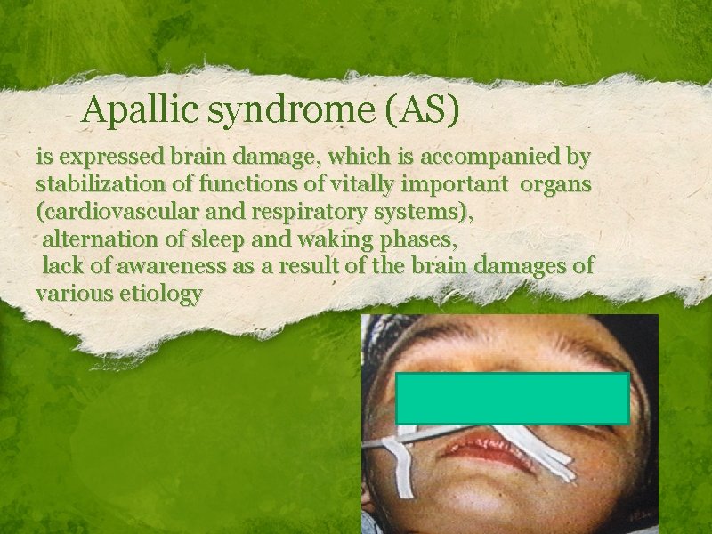 Apallic syndrome (АS) is expressed brain damage, which is accompanied by stabilization of functions