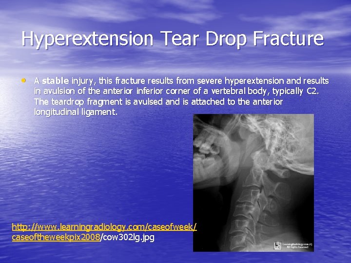 Hyperextension Tear Drop Fracture • A stable injury, this fracture results from severe hyperextension