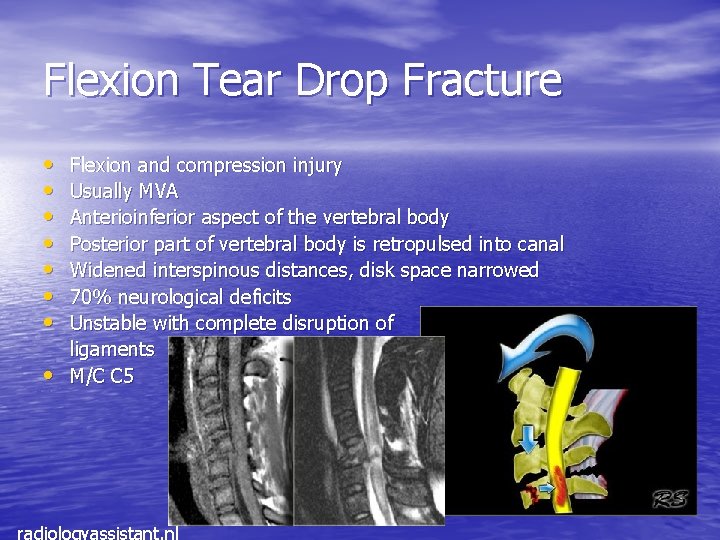 Flexion Tear Drop Fracture • • Flexion and compression injury Usually MVA Anterioinferior aspect