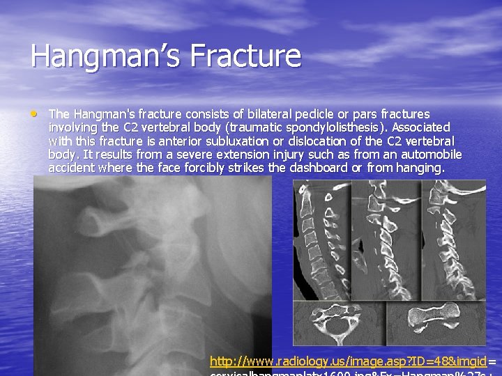 Hangman’s Fracture • The Hangman's fracture consists of bilateral pedicle or pars fractures involving