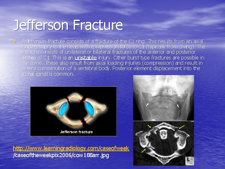 Jefferson Fracture • A Jefferson fracture consists of a fracture of the C 1