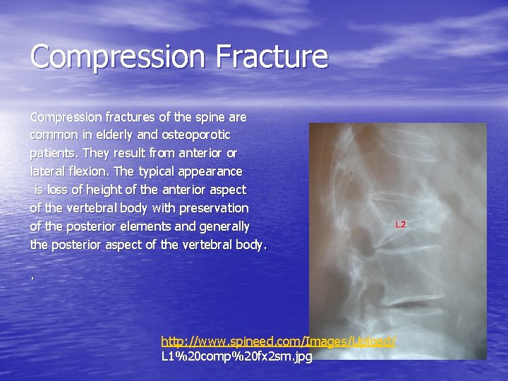 Compression Fracture Compression fractures of the spine are common in elderly and osteoporotic patients.