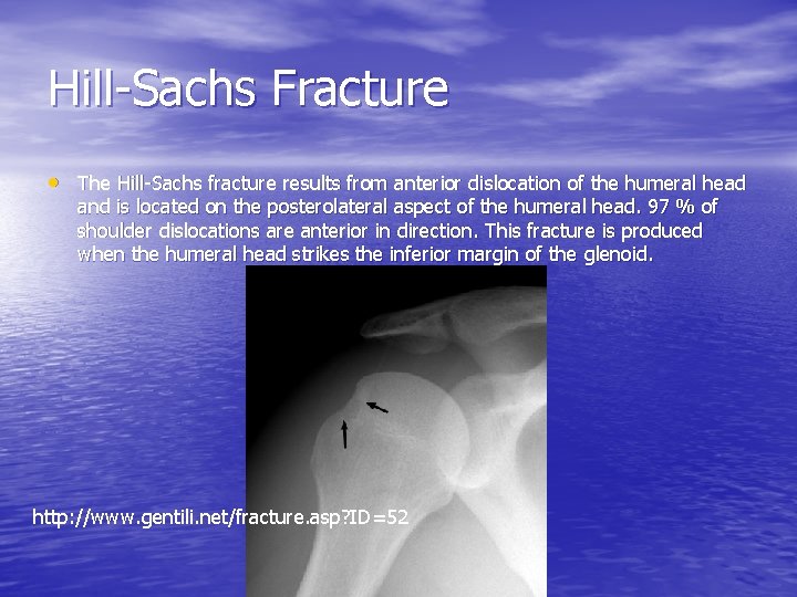 Hill-Sachs Fracture • The Hill-Sachs fracture results from anterior dislocation of the humeral head