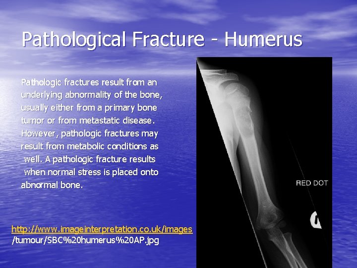 Pathological Fracture - Humerus Pathologic fractures result from an underlying abnormality of the bone,