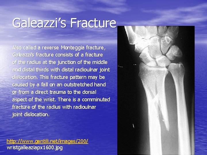 Galeazzi’s Fracture Also called a reverse Monteggia fracture, Galeazzi's fracture consists of a fracture