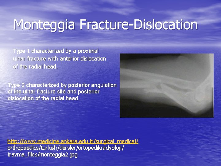 Monteggia Fracture-Dislocation Type 1 characterized by a proximal ulnar fracture with anterior dislocation of