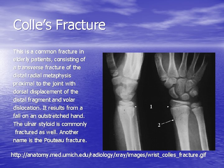 Colle’s Fracture This is a common fracture in elderly patients, consisting of a transverse