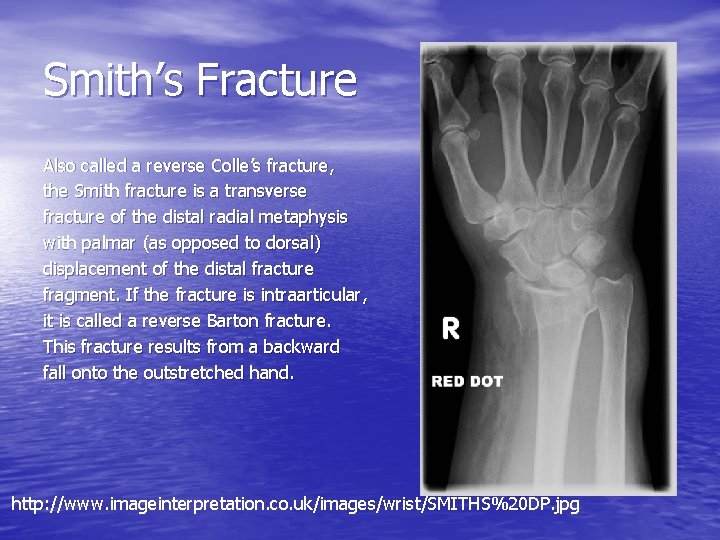 Smith’s Fracture Also called a reverse Colle’s fracture, the Smith fracture is a transverse