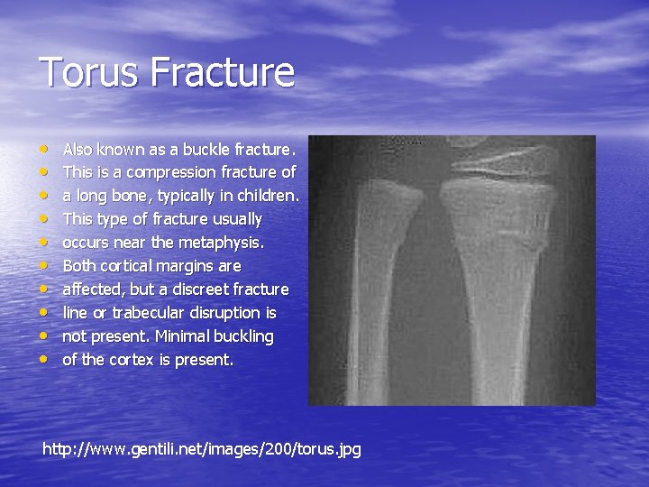 Torus Fracture • • • Also known as a buckle fracture. This is a