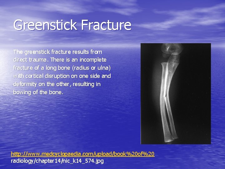 Greenstick Fracture The greenstick fracture results from direct trauma. There is an incomplete fracture