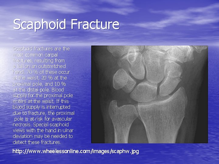 Scaphoid Fracture Scaphoid fractures are the most common carpal fractures, resulting from a fall