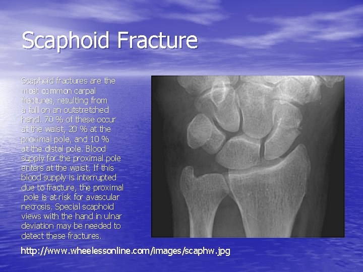 Scaphoid Fracture Scaphoid fractures are the most common carpal fractures, resulting from a fall