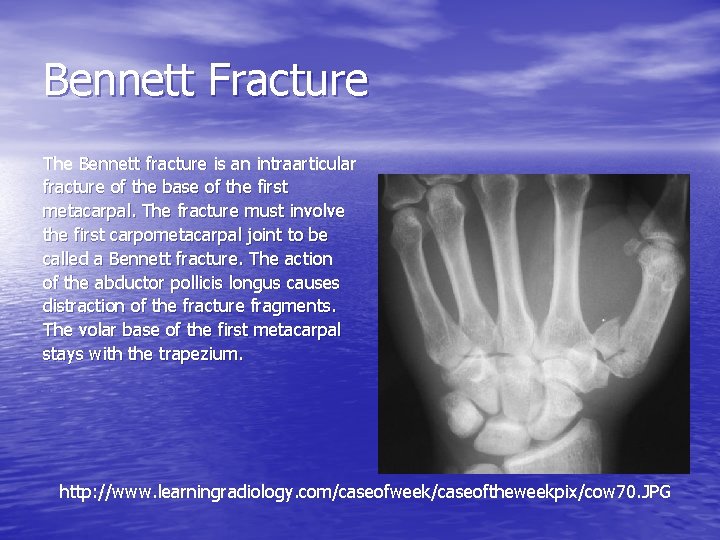 Bennett Fracture The Bennett fracture is an intraarticular fracture of the base of the