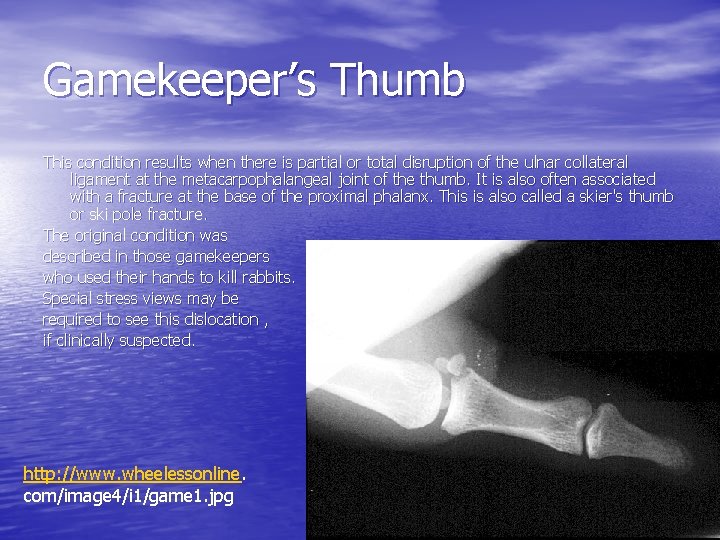 Gamekeeper’s Thumb This condition results when there is partial or total disruption of the