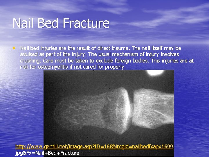 Nail Bed Fracture • Nail bed injuries are the result of direct trauma. The